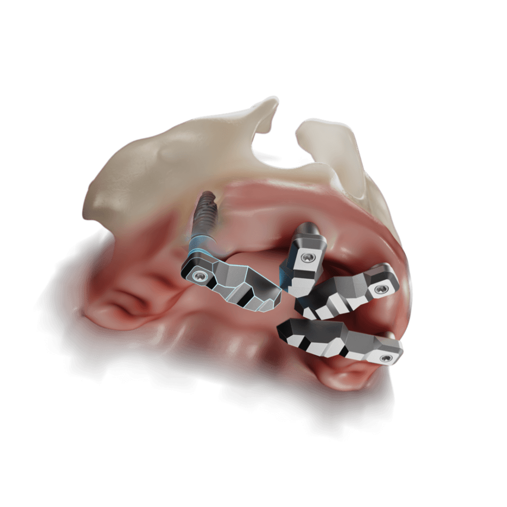 DirectIP Alliedstar per la scansione implantare full-arch